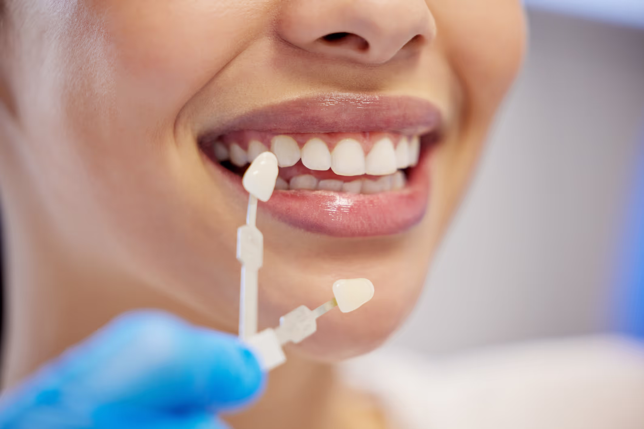 Porcelain veneers smile illustration