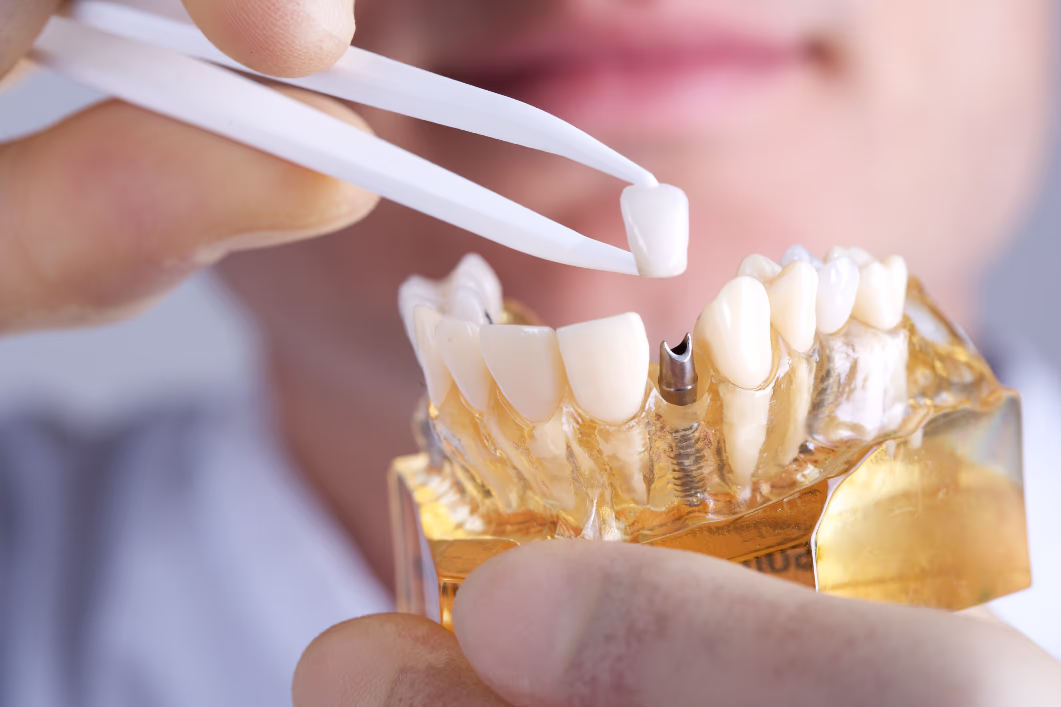 Dental implant procedure illustration