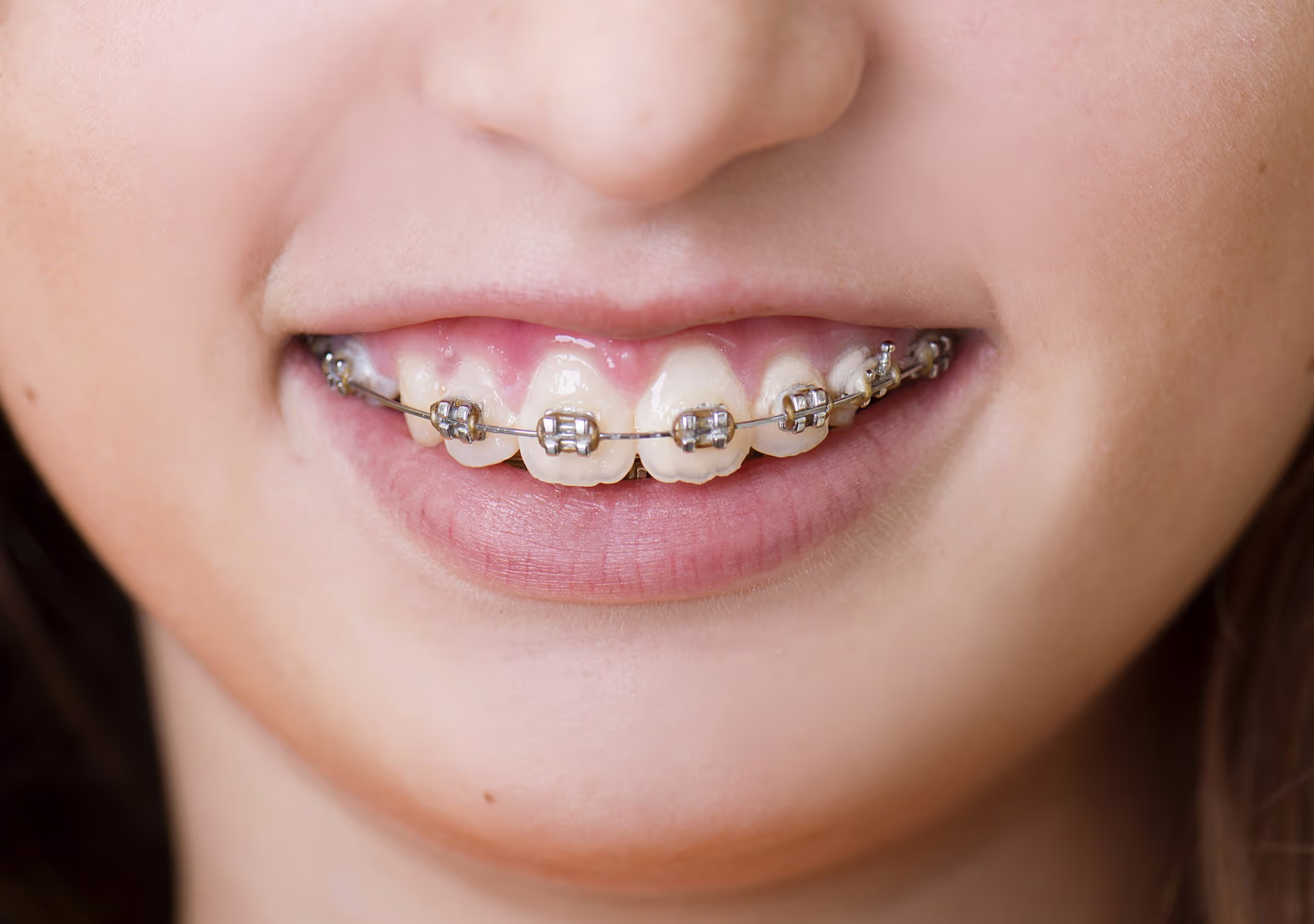 Invisalign clear aligners